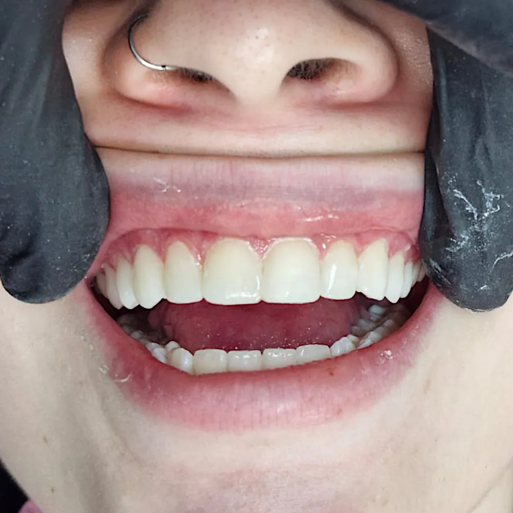 Resultado de diseño de sonrisa