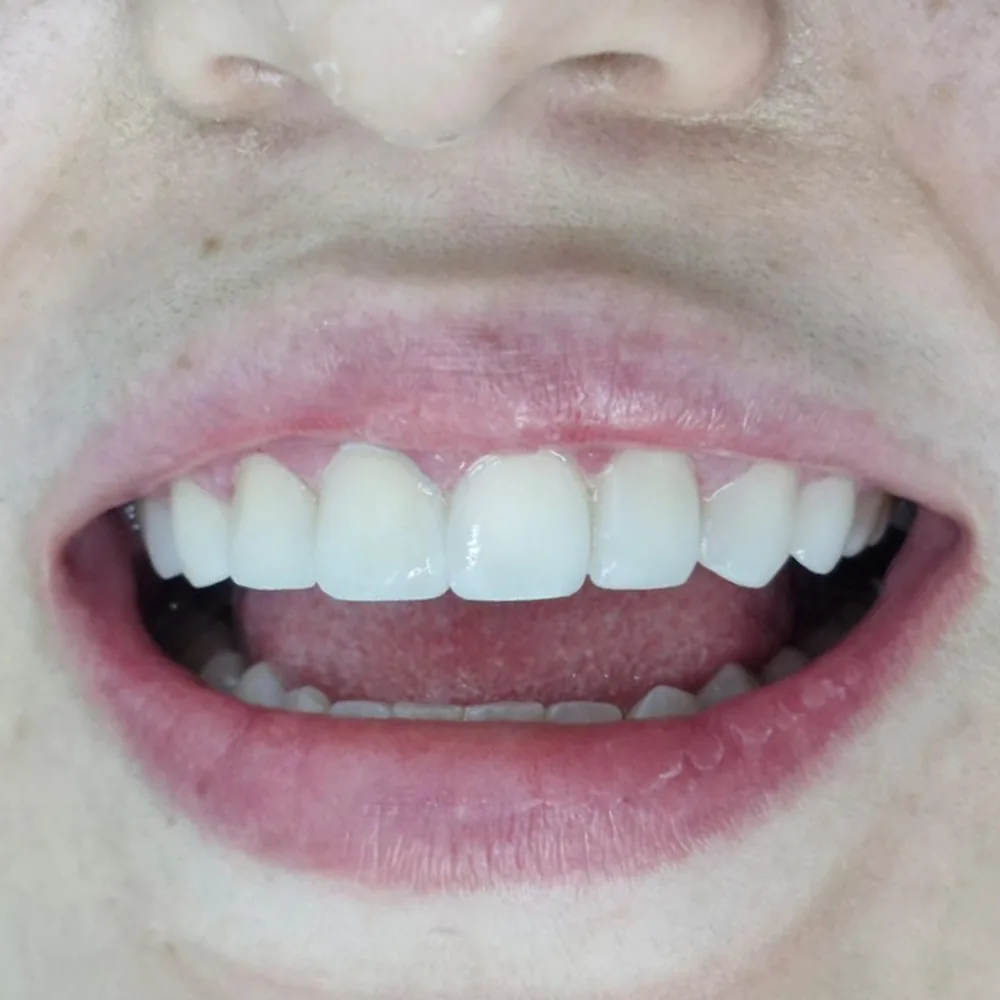 Resultado natural de tratamiento estético dental