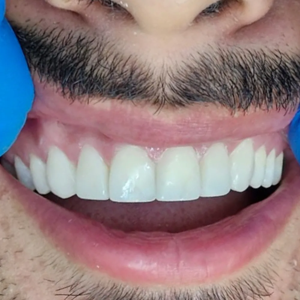 Sonrisa después del tratamiento
