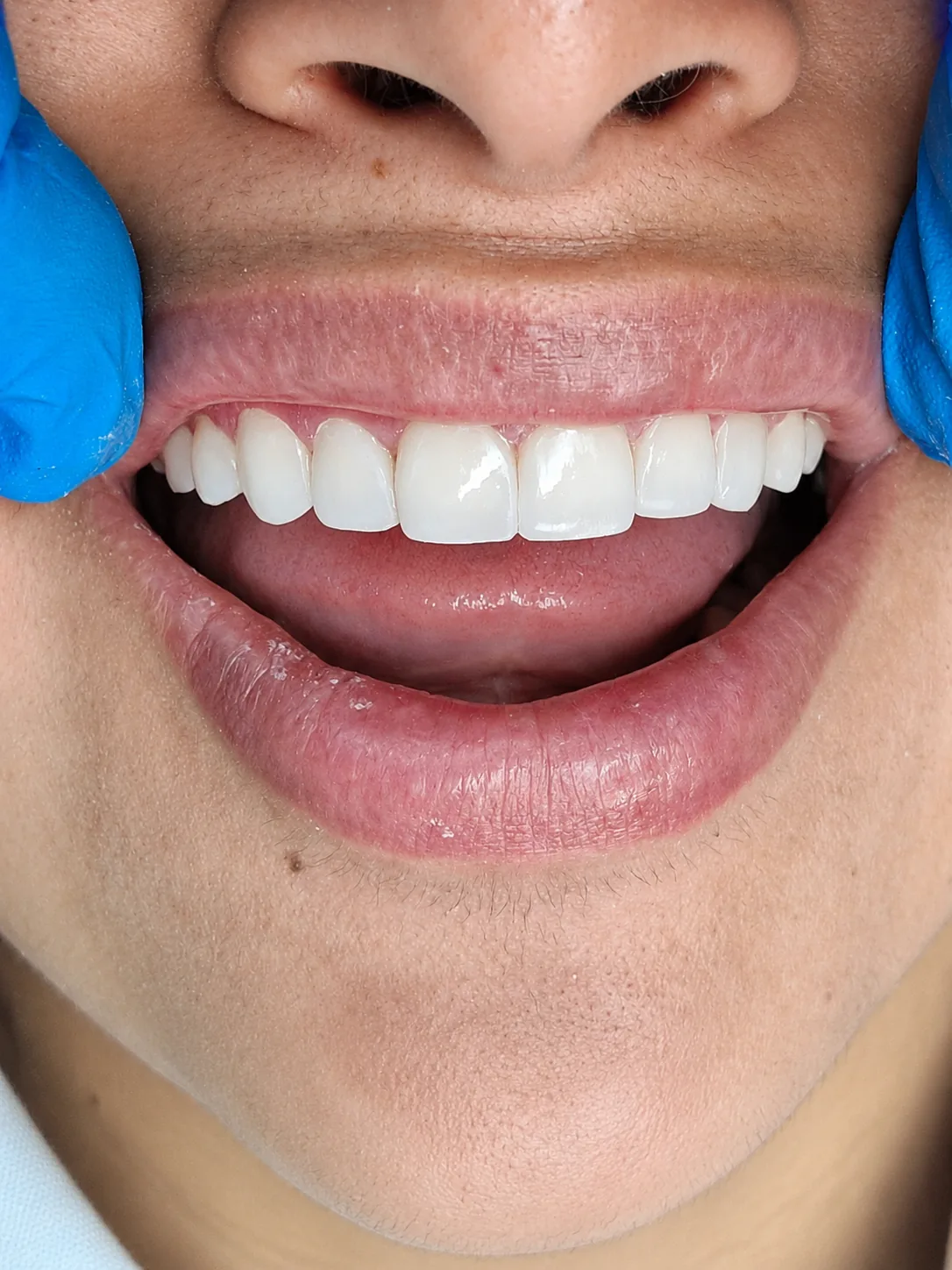 Resultado frontal de una sonrisa natural