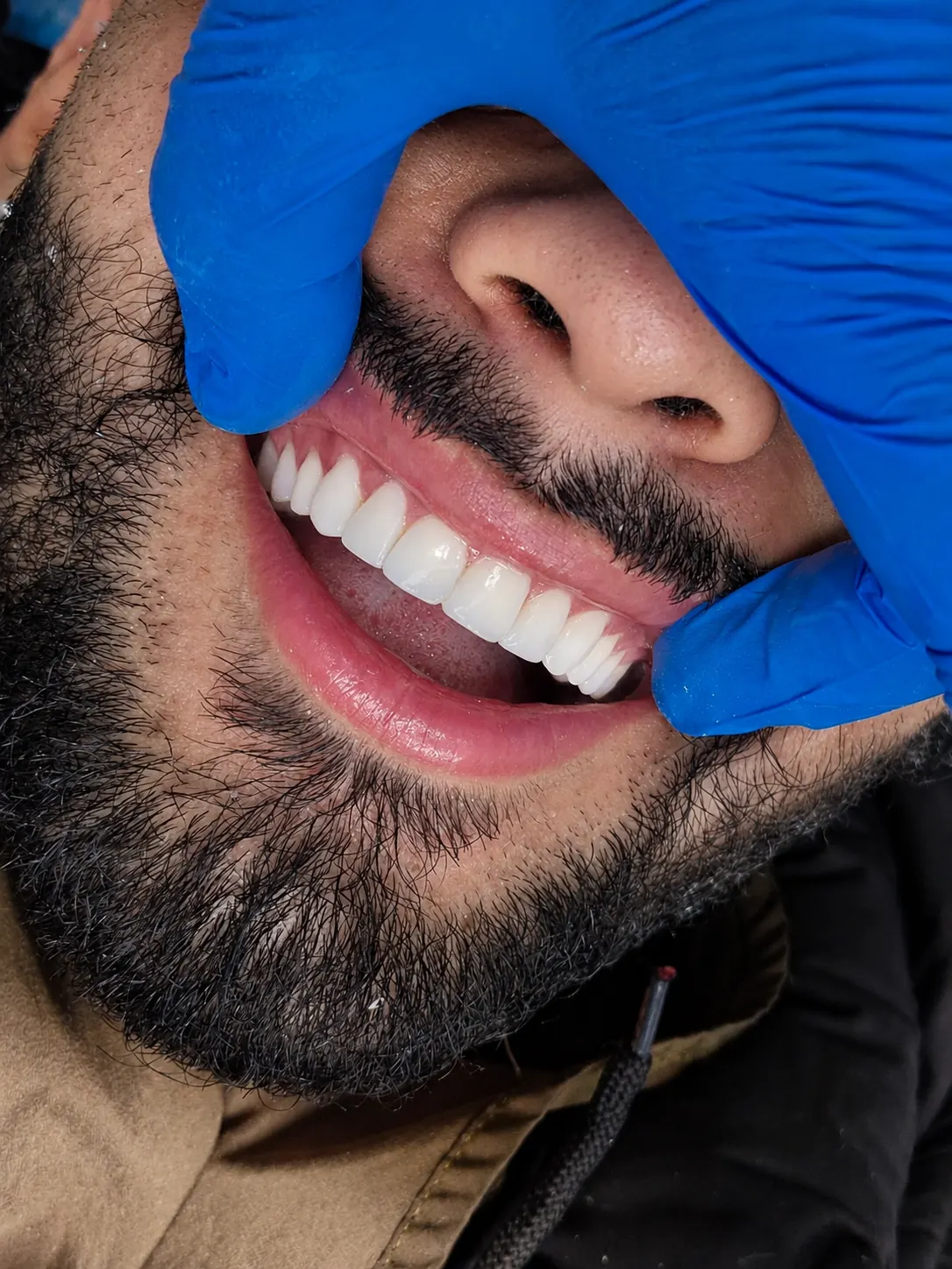 Resultado de diseño de sonrisa visto en ángulo