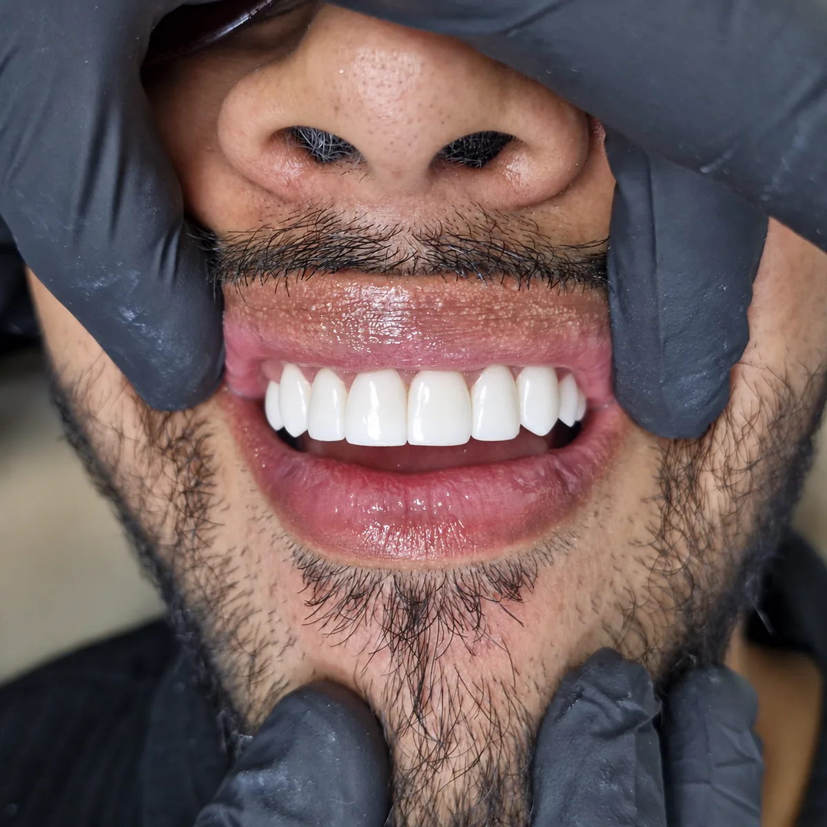 Diseño de sonrisa en resina de alta estética
