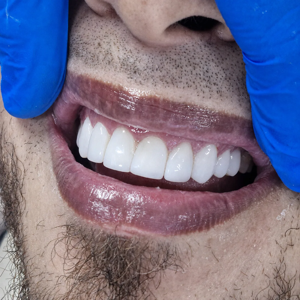 Sonrisa luminosa como referencia de aclaramiento dental