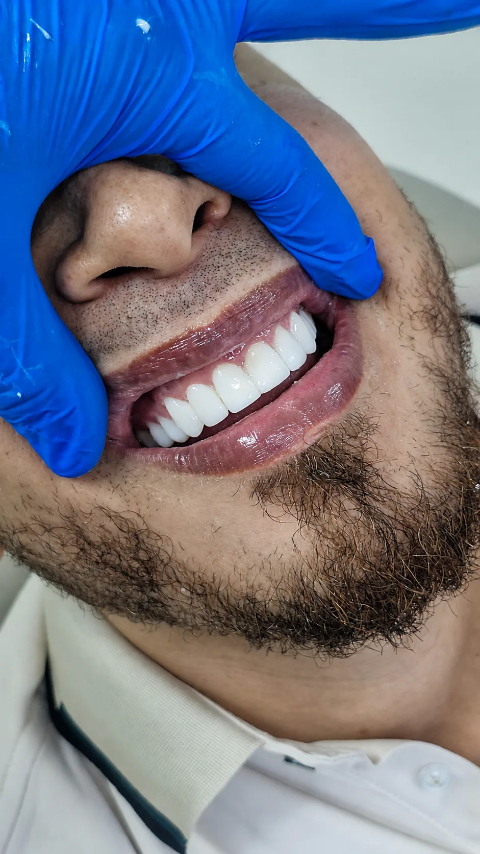 Detalle lateral de una sonrisa después del tratamiento