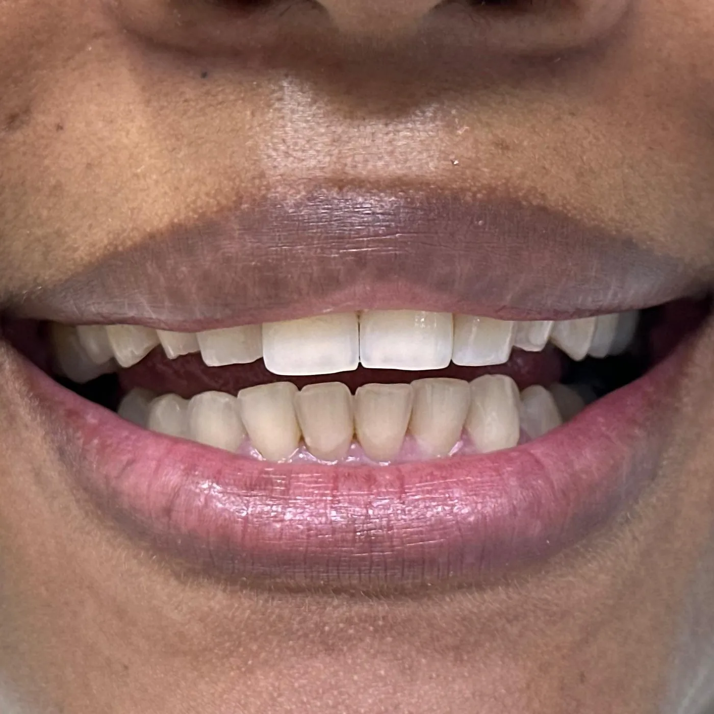 Sonrisa antes del microdiseño