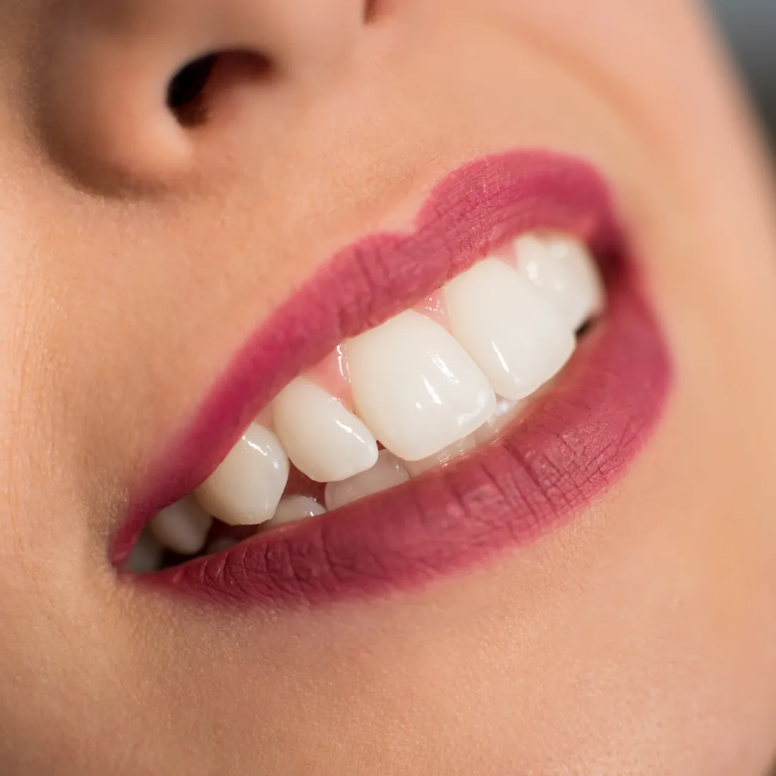 Aclaramiento dental