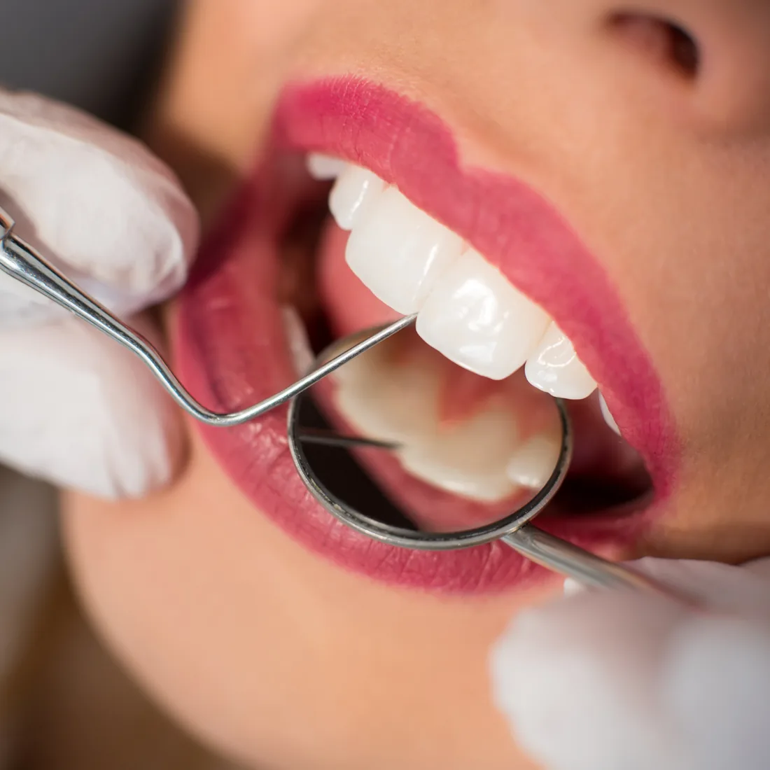 Detalle de resultado estético dental